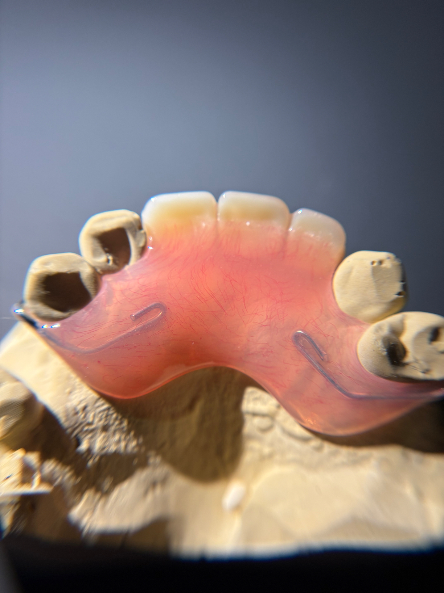 Upper flexible partial with clear clasps seated on stone model