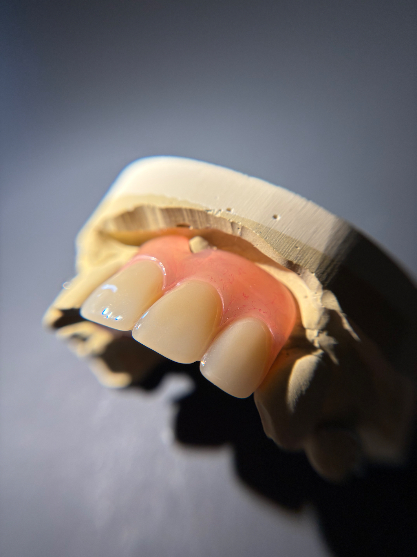 Anterior acrylic partial with characterized gingival shading on stone model