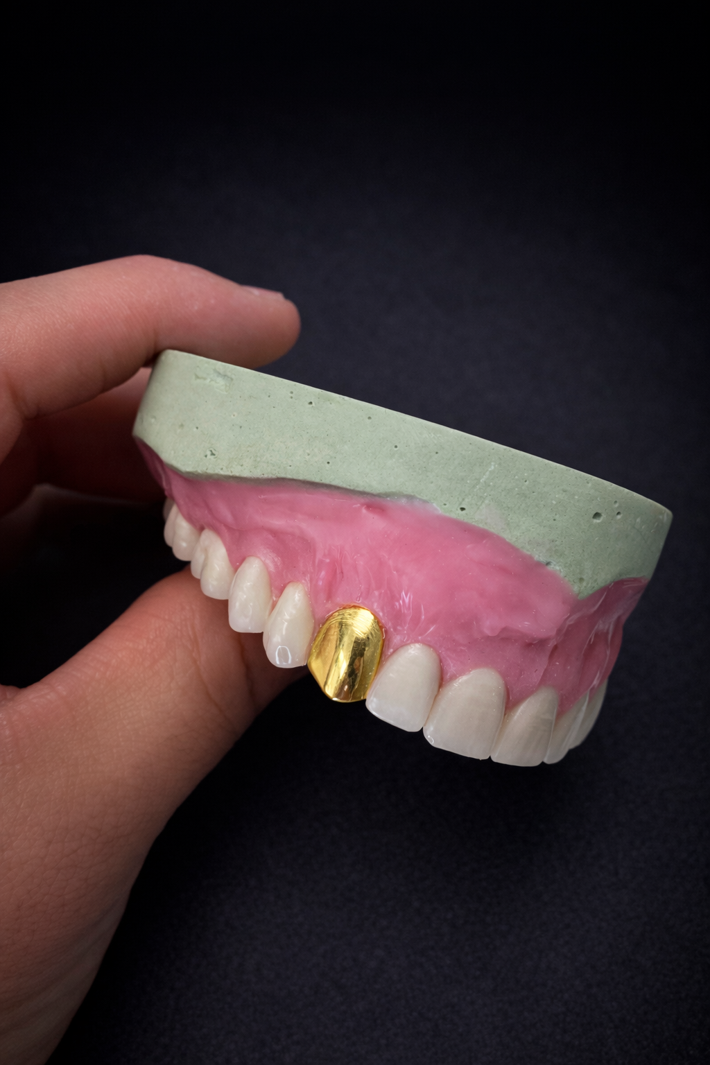 Full upper denture with gold crown detail