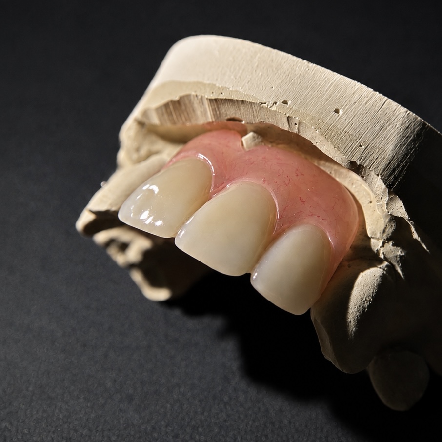 Anterior flexible partial with three natural-shade teeth on model